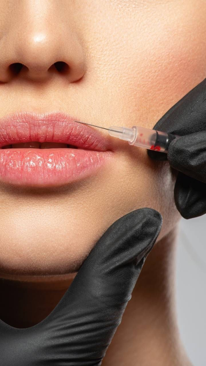 Preenchimento Labial
