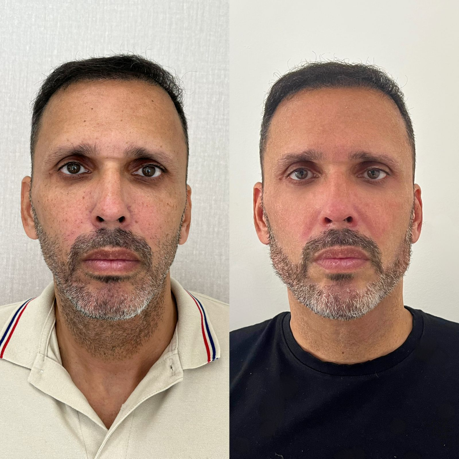 Full Face Exemplo 1 antes e depois